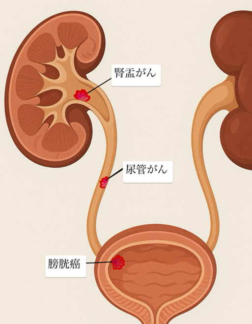 膀胱がんのイメージ画像