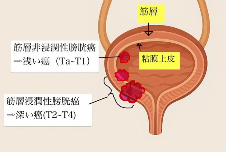 膀胱がん_分類