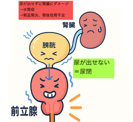 尿が出せないイメージ画像