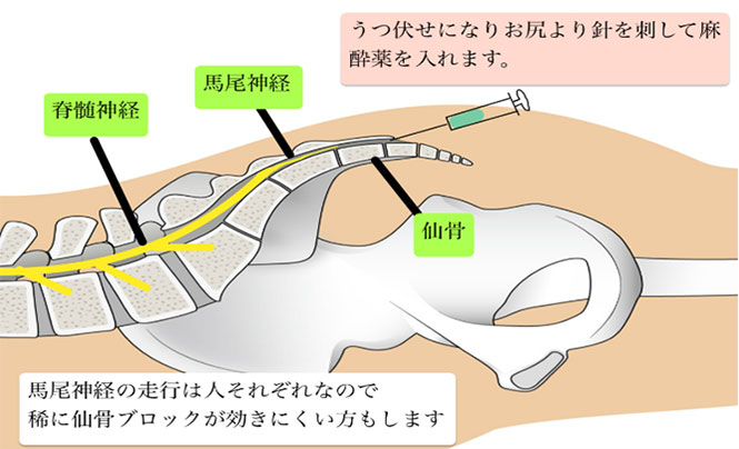 仙骨ブロック