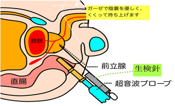生検