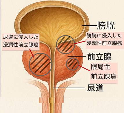 前立腺がん