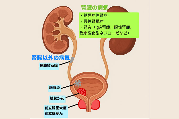 蛋白尿の部位による原因疾患