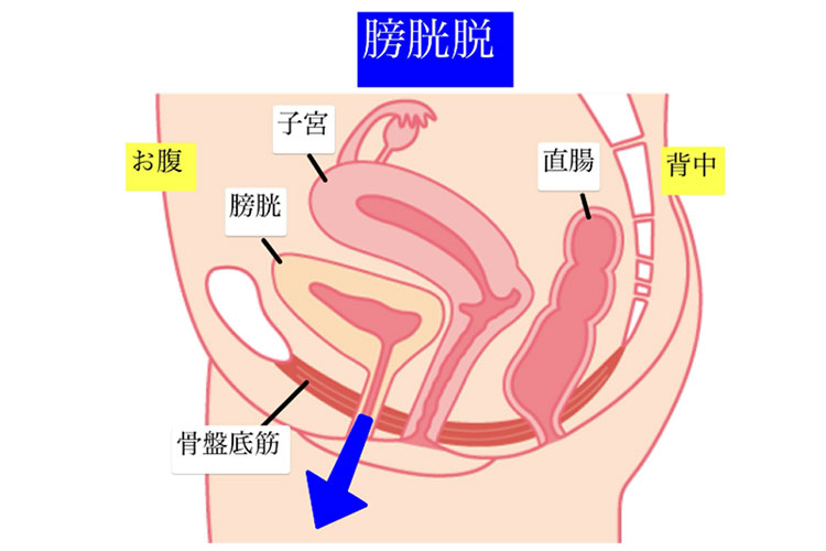 骨盤臓器脱の分類・膀胱脱