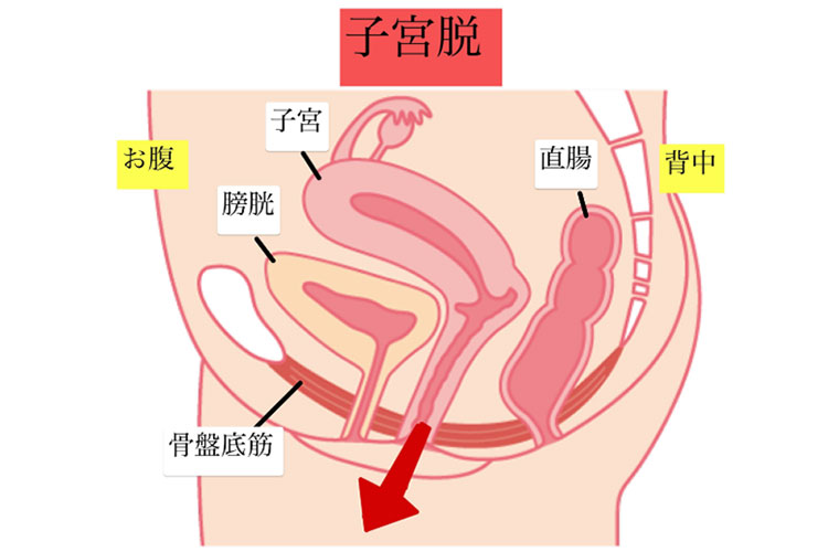 骨盤臓器脱の分類・子宮脱