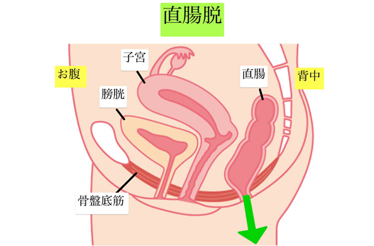 骨盤臓器脱の分類・直腸脱